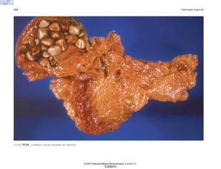 244 Patología especial
FIGURA 10-66. Colelitiasis: cálculos facetados de colesterol.
© 2007 Editorial Médica Panamericana, S.A de C.V.
Cisfarm
 