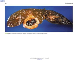 246 Patología especial
FIGURA 10-68. Carcinoma de la vesícula biliar: hay litiasis, engrosamiento intenso de la pared vesicular y colestasis.
© 2007 Editorial Médica Panamericana, S.A de C.V.
Cisfarm
 