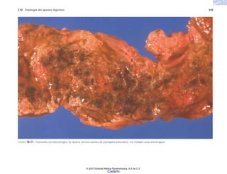 C10 Patología del aparato digestivo 249
FIGURA 10-71. Pancreatitis necrohemorrágica. Se observa necrosis extensa del parénquima pancreático, con múltiples áreas hemorrágicas.
© 2007 Editorial Médica Panamericana, S.A de C.V.
Cisfarm
 