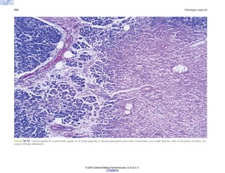 250 Patología especial
FIGURA 10-72. Fotomicrografía de la pancreatitis aguda. En la mitad izquierda se observa parénquima pancreático conservado y en el lado derecho, éste se encuentra necrótico, con
escaso infiltrado inflamatorio.
© 2007 Editorial Médica Panamericana, S.A de C.V.
Cisfarm
 