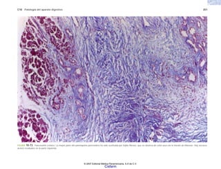 C10 Patología del aparato digestivo 251
FIGURA 10-73. Pancreatitis crónica. La mayor parte del parénquima pancreático ha sido sustituida por tejido fibroso, que se observa de color azul con la tinción de Masson. Hay escasos
ácinos residuales en la parte izquierda.
© 2007 Editorial Médica Panamericana, S.A de C.V.
Cisfarm
 