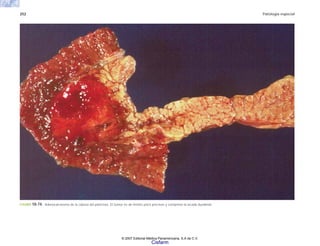 252 Patología especial
FIGURA 10-74. Adenocarcinoma de la cabeza del páncreas. El tumor es de límites poco precisos y comprime la arcada duodenal.
© 2007 Editorial Médica Panamericana, S.A de C.V.
Cisfarm
 