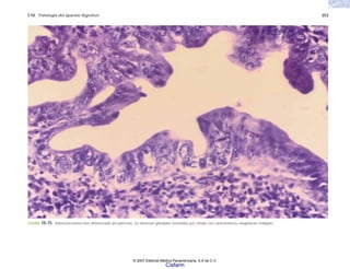 C10 Patología del aparato digestivo 253
FIGURA 10-75. Adenocarcinoma bien diferenciado del páncreas. Se observan glándulas revestidas por células con características neoplásicas malignas.
© 2007 Editorial Médica Panamericana, S.A de C.V.
Cisfarm
 