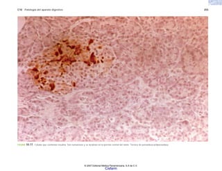 C10 Patología del aparato digestivo 255
FIGURA 10-77. Células que contienen insulina. Son numerosas y se localizan en la porción central del islote. Técnica de peroxidasa-antiperoxidasa.
© 2007 Editorial Médica Panamericana, S.A de C.V.
Cisfarm
 