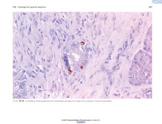 C10 Patología del aparato digestivo 257
FIGURA 10-79. Se identifican células productoras de somatostatina asociadas con células de los conductos. Técnica de peroxidasa.
© 2007 Editorial Médica Panamericana, S.A de C.V.
Cisfarm
 