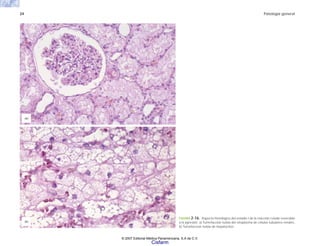 24 Patología general
FIGURA 2-16. Aspecto histológico del estadio I de la reacción celular reversible
a la agresión. a) Tumefacción turbia del citoplasma de células tubulares renales.
b) Tumefacción turbia de hepatocitos.
(a)
(b)
© 2007 Editorial Médica Panamericana, S.A de C.V.
Cisfarm
 