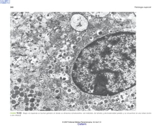 260 Patología especial
FIGURA 10-82. Abajo a la izquierda se ilustran gránulos en donde se almacena somatostatina; son redondos, de tamaño y electrodensidad variable y se encuentran en una célula vecina
a una célula β.
© 2007 Editorial Médica Panamericana, S.A de C.V.
Cisfarm
 