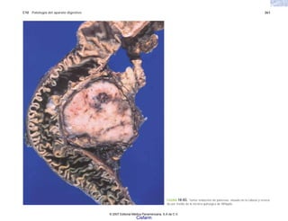 C10 Patología del aparato digestivo 261
FIGURA 10-83. Tumor endocrino de páncreas, situado en la cabeza y reseca-
do por medio de la técnica quirúrgica de Whipple.
© 2007 Editorial Médica Panamericana, S.A de C.V.
Cisfarm
 