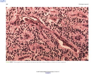 262 Patología especial
FIGURA 10-84. Fotomicrografía de un tumor endocrino del páncreas que ilustra cordones celulares en contacto con vasos sanguíneos.
© 2007 Editorial Médica Panamericana, S.A de C.V.
Cisfarm
 