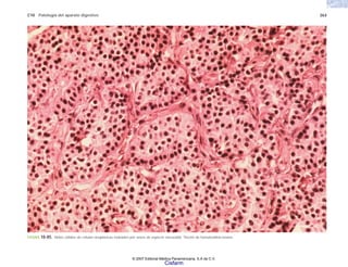 C10 Patología del aparato digestivo 263
FIGURA 10-85. Nidos sólidos de células neoplásicas rodeados por vasos de aspecto sinusoidal. Tinción de hematoxilina-eosina.
© 2007 Editorial Médica Panamericana, S.A de C.V.
Cisfarm
 