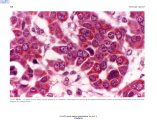 264 Patología especial
FIGURA 10-86 . Las células de este tumor poseen gastrina en el citoplasma, evidenciada por la técnica de peroxidasa-antiperoxidasa unida a un anticuerpo antigastrina. El paciente tenía
síndrome de Zollinger-Ellison.
© 2007 Editorial Médica Panamericana, S.A de C.V.
Cisfarm
 