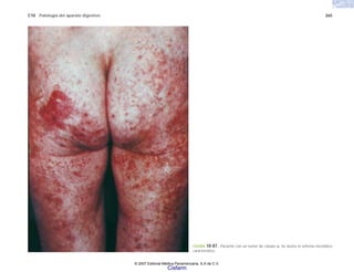 C10 Patología del aparato digestivo 265
FIGURA 10-87. Paciente con un tumor de células α. Se ilustra el eritema necrolítico
característico.
© 2007 Editorial Médica Panamericana, S.A de C.V.
Cisfarm
 