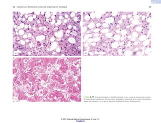 C2 Lesiones en diferentes niveles de organización biológica 25
(c)
(a) (b)
FIGURA 2-17. Esteatosis hepática. a) y b) Esteatosis en dos casos de alcoholismo crónico.
El núcleo de los hepatocitos afectados está empujado a la periferia de la célula. c) Esteatosis
aguda del embarazo, en la que la grasa no desplaza el núcleo del hepatocito.
© 2007 Editorial Médica Panamericana, S.A de C.V.
Cisfarm
 