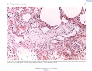 C11 Patología del aparato respiratorio 273
FIGURA 11-3. Corte de pulmón que muestra un cuerpo de Masson formado por fibroblastos que van de un alveolo al siguiente a través de los poros interalveolares. Esto representa la
organización de un exudado. Además, se observa infiltrado inflamatorio crónico en el resto del parénquima pulmonar.
© 2007 Editorial Médica Panamericana, S.A de C.V.
Cisfarm
 