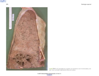 274 Patología especial
FIGURA 11-4. Corte parasagital de un pulmón con neumonía la cual se ha abscedado y cavi-
tado. Existe acentuado engrosamiento difuso de la pleura.
© 2007 Editorial Médica Panamericana, S.A de C.V.
Cisfarm
 