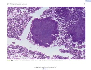 C11 Patología del aparato respiratorio 275
FIGURA 11-5. Actinomicosis. Se observa un denso exudado purulento en medio del cual se presentan “gránulos actinomicóticos.”
© 2007 Editorial Médica Panamericana, S.A de C.V.
Cisfarm
 