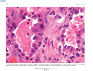 276 Patología especial
FIGURA 11-6. Neumonía por virus de inclusión citomegálica. Se aprecia un acercamiento de tabique alveolar muy engrosado. En una de las células que reviste a uno de los espacios se
aprecia una inclusión intranuclear rodeada de un halo claro. Esta inclusión es muy característica del efecto citopático causado por el virus de inclusión citomegálica.
© 2007 Editorial Médica Panamericana, S.A de C.V.
Cisfarm
 