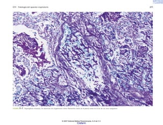C11 Patología del aparato respiratorio 277
FIGURA 11-7. Aspergilosis invasora. Se observan los organismos como filamentos tanto en la pared como en la luz de un vaso sanguíneo.
© 2007 Editorial Médica Panamericana, S.A de C.V.
Cisfarm
 