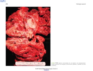 278 Patología especial
FIGURA 11-8. Aspecto macroscópico de un pulmón con bronquiectasias.
Pueden apreciarse los bronquios enormemente dilatados y rodeados de areas
de fibrosis.
© 2007 Editorial Médica Panamericana, S.A de C.V.
Cisfarm
 