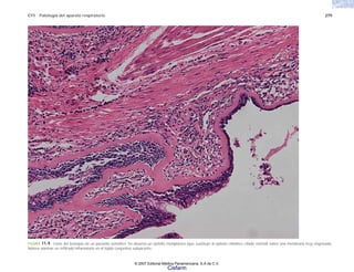 C11 Patología del aparato respiratorio 279
FIGURA 11-9. Corte del bronquio de un paciente asmático. Se observa un epitelio metaplásico (que sustituye al epitelio cilíndrico ciliado normal) sobre una membrana muy engrosada.
Nótese además un infiltrado inflamatorio en el tejido conjuntivo subyacente.
© 2007 Editorial Médica Panamericana, S.A de C.V.
Cisfarm
 
