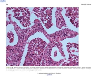 280 Patología especial
FIGURA 11-10. Neumonía intersticial descamativa. Se aprecian algunos alvéolos de paredes moderadamente engrosadas por un infiltrado inflamatorio de linfocitos y algunos macrófagos.
Lo más llamativo en el aspecto histológico de esta lesión es la presencia de numerosos macrófagos que ocupan y llenan los espacios alveolares. En el citoplasma de algunos macrófagos
se aprecia un pigmento ocre que se le ha denominado pigmento del fumador.
© 2007 Editorial Médica Panamericana, S.A de C.V.
Cisfarm
 