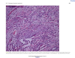 C11 Patología del aparato respiratorio 281
FIGURA 11-11. Neumonía intersticial de tipo usual o clásico. En esta condición existen zonas de pulmón con gran distorsión de la arquitectura normal del pulmón debido a fibrosis inters-
titicial alternando con áreas de pulmón normal. En la ilustración se puede observar un área de fibrosis con uno de los llamados “focos fibroblásticos” muy característicos de esta lesión.
© 2007 Editorial Médica Panamericana, S.A de C.V.
Cisfarm
 
