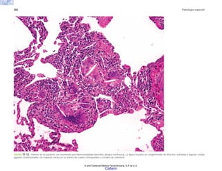282 Patología especial
FIGURA 11-12. Pulmón de un paciente con neumonitis por hipersensibilidad (alveolitis alérgica extrínseca). La figura muestra un conglomerado de linfocitos rodeando a algunas células
gigantes multinucleadas con espacios vacíos en su interior los cuales corresponden a cristales de colesterol.
© 2007 Editorial Médica Panamericana, S.A de C.V.
Cisfarm
 