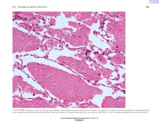 C11 Patología del aparato respiratorio 283
FIGURA 11-13. Proteinosis alveolar. Se observan varios alvéolos cuyos tabiques no llaman mayormente la atención, son delgados y de aspecto normal sin embargo, los espacios alveolares
están ocupados por abundante material eosinofílico, finamente granular y en algunas zonas grumoso constituido por surfactante el cual se acumula exageradamente en estos pacientes.
© 2007 Editorial Médica Panamericana, S.A de C.V.
Cisfarm
 
