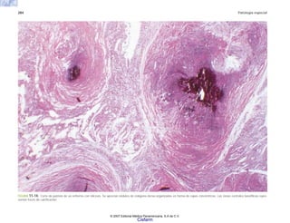 284 Patología especial
FIGURA 11-14. Corte de pulmón de un enfermo con silicosis. Se aprecian nódulos de colágena densa organizados en forma de capas concéntricas. Las zonas centrales basofílicas repre-
sentan focos de calcificación.
© 2007 Editorial Médica Panamericana, S.A de C.V.
Cisfarm
 