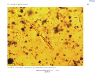 C11 Patología del aparato respiratorio 285
FIGURA 11-15. Cuerpo ferruginoso, constituido por una fibra central de asbestos rodeada de pigmento férrico.
© 2007 Editorial Médica Panamericana, S.A de C.V.
Cisfarm
 