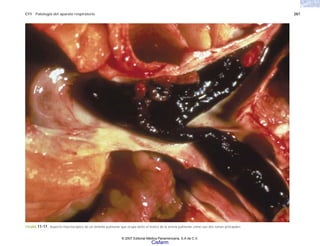 C11 Patología del aparato respiratorio 287
FIGURA 11-17. Aspecto macroscópico de un émbolo pulmonar que ocupa tanto el tronco de la arteria pulmonar como sus dos ramas principales.
© 2007 Editorial Médica Panamericana, S.A de C.V.
Cisfarm
 