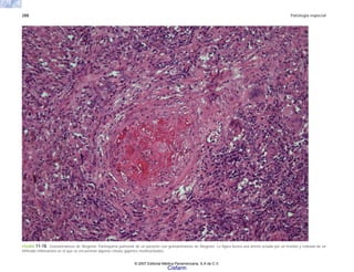 288 Patología especial
FIGURA 11-18. Granulomatosis de Wegener. Parénquima pulmonar de un paciente con granulomatosis de Wegener. La figura ilustra una arteria ocluida por un trombo y rodeada de un
infiltrado inflamatorio en el que se encuentran algunas células gigantes multinucleadas.
© 2007 Editorial Médica Panamericana, S.A de C.V.
Cisfarm
 