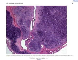 C11 Patología del aparato respiratorio 289
FIGURA 11-19. Hamartoma pulmonar. La figura muestra un nódulo bien circunscrito, formado por cartílago con espacios ocasionales que pueden tener revestimiento en algunos sitios.
© 2007 Editorial Médica Panamericana, S.A de C.V.
Cisfarm
 