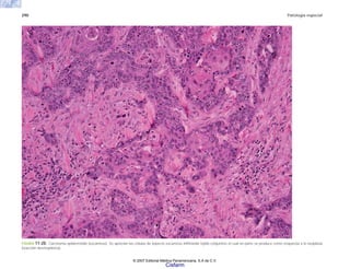 290 Patología especial
FIGURA 11-20. Carcinoma epidermoide (escamoso). Se aprecian las células de aspecto escamoso infiltrando tejido conjuntivo el cual en parte se produce como respuesta a la neoplasia
(reacción desmoplásica).
© 2007 Editorial Médica Panamericana, S.A de C.V.
Cisfarm
 