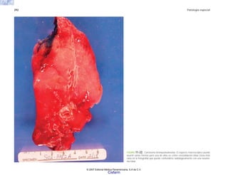 292 Patología especial
FIGURA 11-22. Carcinoma bronquioloalveolar. El aspecto macroscópico puede
asumir varias formas pero una de ellas es como consolidación lobar (zona más
clara en la fotografía) que puede confundirse radiológicamente con una neumo-
nía lobar.
© 2007 Editorial Médica Panamericana, S.A de C.V.
Cisfarm
 