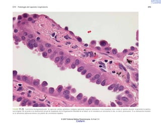C11 Patología del aparato respiratorio 293
FIGURA 11-23. Carcinoma bronquioloalveolar. Se aprecian células epiteliales malignas tapizando espacios alveolares. Esta neoplasia crece sobre el epitelio alveolar respetando la aquitec-
tura original. De acuerdo a la clasificación actual de neoplasias de la Organización Mundial de la Salud, se le considera un carcinoma in situ, es decir, preinvasivo. Si se demuestra invasión,
se le denomina adenocarcinoma con patrón de crecimiento lepídico.
© 2007 Editorial Médica Panamericana, S.A de C.V.
Cisfarm
 