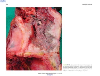 294 Patología especial
FIGURA 11-24. Acercamiento del aspecto macroscopico de
un mesotelioma. Esta neoplasia, de muy mal pronóstico, tiende
a crecer alrededor del pulmón. Lo característico es que rodea
al pulmón sin gran invasión parenquimatosa pero siguiendo los
espacios ocupados por mesotelio (pleura, peritoneo).
© 2007 Editorial Médica Panamericana, S.A de C.V.
Cisfarm
 