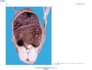 28 Patología general
FIGURA 2-20. Hiperplasia nodular de la próstata, con estenosis de la
uretra prostática.
© 2007 Editorial Médica Panamericana, S.A de C.V.
Cisfarm
 