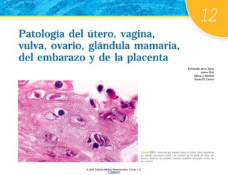 Patología del útero, vagina,
vulva, ovario, glándula mamaria,
del embarazo y de la placenta
Patología del útero, vagina,
vulva, ovario, glándula mamaria,
del embarazo y de la placenta
Fernando de la Torre
Jaime Prat
María J. Merino
Paolo Di Castro
FIGURA 12-1. Infección por herpes virus en vulva. Zona superficial
de epitelio escamoso vulvar con cuerpos de inclusión de virus del
herpes. Nótense los grandes cuerpos acidófilos alargados dentro de
los núcleos.
12
© 2007 Editorial Médica Panamericana, S.A de C.V.
Cisfarm
 