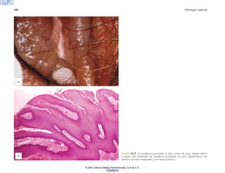 300 Patología especial
FIGURA 12-2. a) Condiloma acuminado en labio menor de vulva. Nódulo blanco
y papilar, bien delimitado. b) Condiloma acuminado de vulva. Papilomatosis con
epitelio escamoso engrosado y con hiperqueratosis.
(a)
(b)
© 2007 Editorial Médica Panamericana, S.A de C.V.
Cisfarm
 