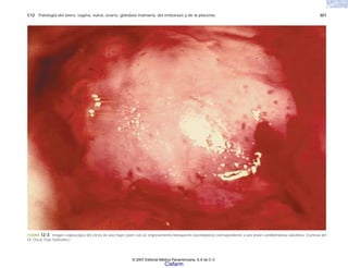 C12 Patología del útero, vagina, vulva, ovario, glándula mamaria, del embarazo y de la placenta 301
FIGURA 12-3. Imagen colposcópca del cérvix de una mujer joven con un engrosamiento blanquecino (acetoblanco) correspondiente a una lesión condilomatosa subclínica. (Cortesía del
Dr. Óscar Trejo Solórzano.)
© 2007 Editorial Médica Panamericana, S.A de C.V.
Cisfarm
 