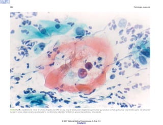 302 Patología especial
FIGURA 12-4. Condiloma de cérvix. El efecto citopático del VPH en una zona de destrucción citoplásmica perinuclear que produce un halo perinuclear característico junto con alteración
nuclear. A estas células escamosas alteradas se les denomina coilocitos. También se aprecia macrocitosis y binucleación.
© 2007 Editorial Médica Panamericana, S.A de C.V.
Cisfarm
 