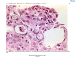 C12 Patología del útero, vagina, vulva, ovario, glándula mamaria, del embarazo y de la placenta 303
FIGURA 12-5. Cervicitis por clamidia. Epitelio escamoso metaplásico del cérvix con pequeñas vacuolas citoplásmicas y corpúsculos en su interior correspondientes a inclusiones de cla-
midia.
© 2007 Editorial Médica Panamericana, S.A de C.V.
Cisfarm
 