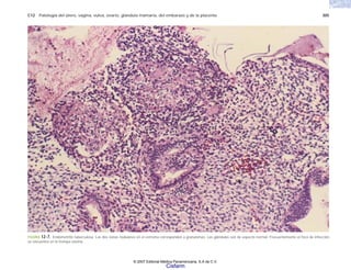 C12 Patología del útero, vagina, vulva, ovario, glándula mamaria, del embarazo y de la placenta 305
FIGURA 12-7. Endometritis tuberculosa. Las dos zonas nodulares en el estroma corresponden a granulomas. Las glándulas son de aspecto normal. Frecuentemente el foco de infección
se encuentra en la trompa uterina.
© 2007 Editorial Médica Panamericana, S.A de C.V.
Cisfarm
 