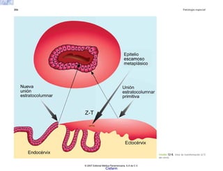 306 Patología especial
FIGURA 12-8. Zona de transformación (Z-T)
del cérvix.
© 2007 Editorial Médica Panamericana, S.A de C.V.
Cisfarm
 