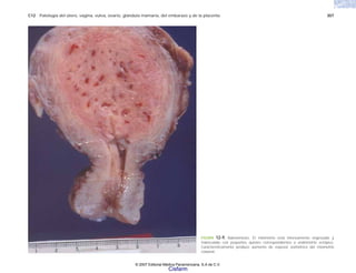 C12 Patología del útero, vagina, vulva, ovario, glándula mamaria, del embarazo y de la placenta 307
FIGURA 12-9. Adenomiosis. El miometrio está intensamente engrosado y
trabeculado con pequeños quistes correspondientes a endometrio ectópico.
Característicamente produce aumento de espesor asimétrico del miometrio
corporal.
© 2007 Editorial Médica Panamericana, S.A de C.V.
Cisfarm
 