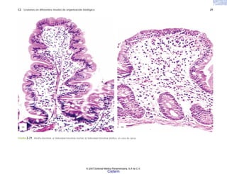 C2 Lesiones en diferentes niveles de organización biológica 29
FIGURA 2-21. Atrofia intestinal. a) Vellosidad intestinal normal. b) Vellosidad intestinal atrófica, en caso de sprue.
(b)
(a)
© 2007 Editorial Médica Panamericana, S.A de C.V.
Cisfarm
 