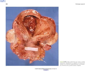 308 Patología especial
FIGURA 12-10. Pólipo endometrial que ocupa la cavidad
endometrial. Habitualmente se adaptan a la forma de la
cavidad y no la deforman significativamente. Son blandos,
de crecimiento lento y pueden producir sangrado.
© 2007 Editorial Médica Panamericana, S.A de C.V.
Cisfarm
 
