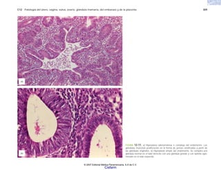 C12 Patología del útero, vagina, vulva, ovario, glándula mamaria, del embarazo y de la placenta 309
FIGURA 12-11. a) Hiperplasia adenomatosa o compleja del endometrio. Las
glándulas muestran proliferación en la forma de yemas ramificadas a partir de
las glándulas originales. b) Hiperplasia simple del endometrio. Se compara una
glándula normal en el lado derecho con una glándula grande y con epitelio aglo-
merado en el lado izquierdo.
(a)
(b)
© 2007 Editorial Médica Panamericana, S.A de C.V.
Cisfarm
 