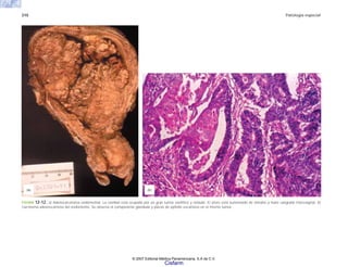 310 Patología especial
FIGURA 12-12. a) Adenocarcinoma endometrial. La cavidad está ocupada por un gran tumor exofítico y nodular. El útero está aumentado de tamaño y hubo sangrado transvaginal. b)
Carcinoma adenoscamoso del endometrio. Se observa el componente glandular y placas de epitelio escamoso en el mismo tumor.
(a) (b)
© 2007 Editorial Médica Panamericana, S.A de C.V.
Cisfarm
 